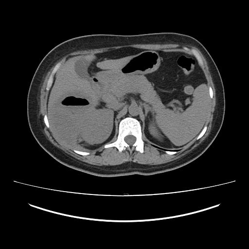 Ascending retrocecal appendicitis with liver abscesses (Radiopaedia 60066-67615 Axial non-contrast 27).jpg