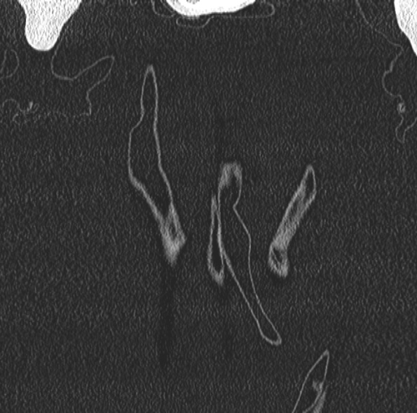 Aspergilloma- with Monod sign (Radiopaedia 44737-48532 Coronal lung window 63).jpg