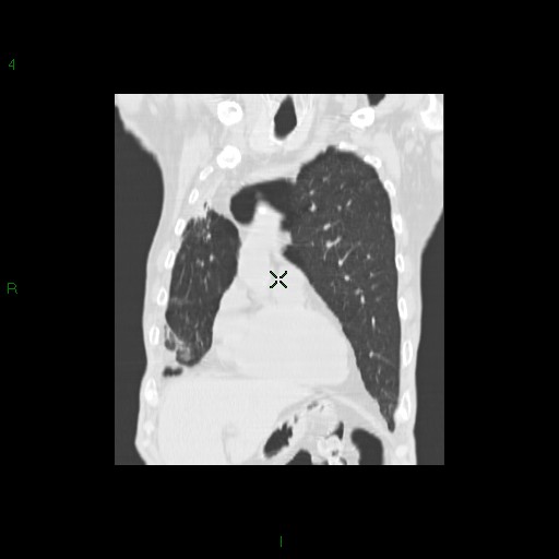 File:Aspergilloma (Radiopaedia 14842-14787 Coronal lung window 10).jpg