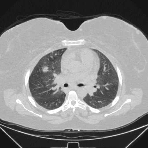 Aspergilloma (Radiopaedia 39611-41932 Axial lung window 54).jpg