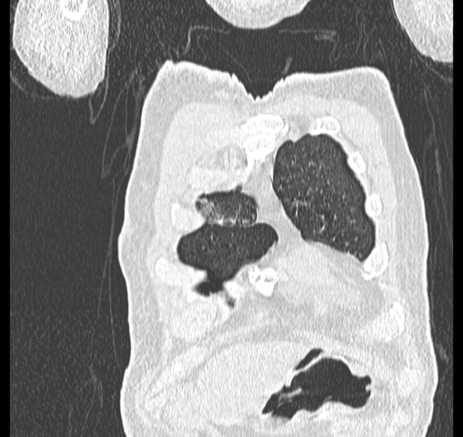 Aspergilloma (Radiopaedia 44592-48327 Coronal lung window 3).jpg