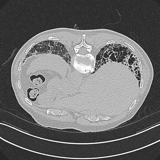 File:Aspergilloma on background pulmonary fibrosis (Radiopaedia 60942-68757 Axial lung window 29).jpg