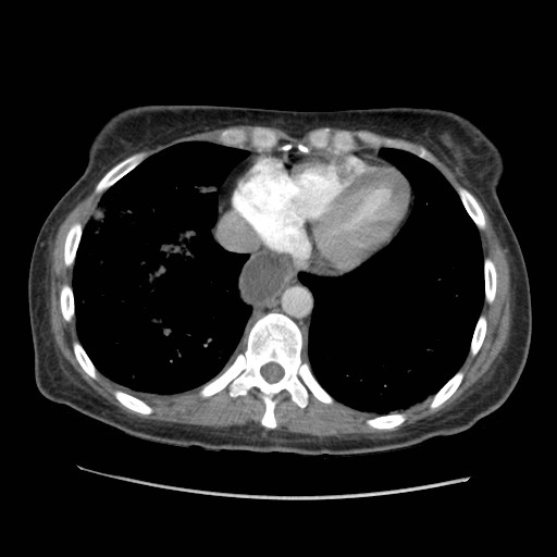 File:Aspiration pneumonia secondary to laparoscopic banding (Radiopaedia 18345-18183 A 40).jpg