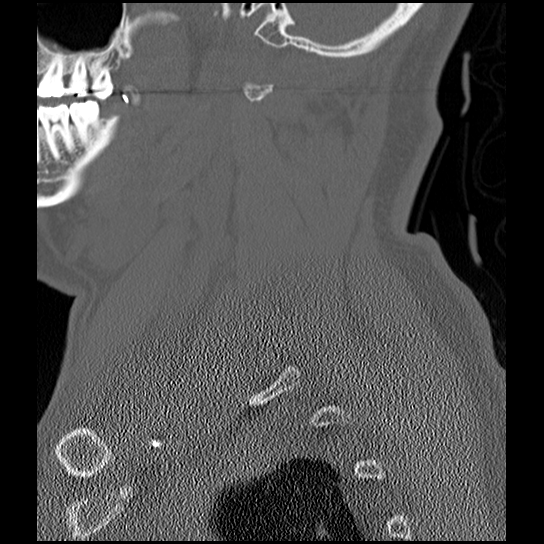Atlanto-occipital dissociation injury (Radiopaedia 29274-29698 Sagittal bone window 11).png
