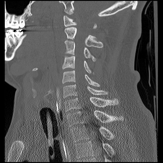 File:Atlanto-occipital dissociation injury (Radiopaedia 29274-29698 Sagittal bone window 33).png