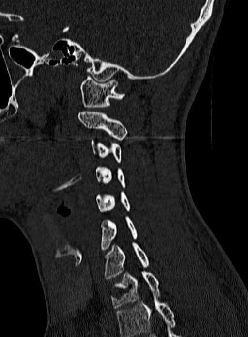 Atlantoaxial subluxation (Radiopaedia 44681-48450 Sagittal bone window 119).jpg