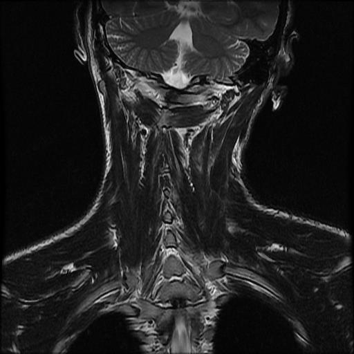 File:Atlas fracture (Radiopaedia 64277-73052 Coronal T2 1).jpg