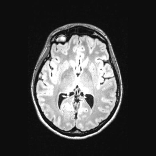 Atretic encephalocoele with inferior vermis hypoplasia (Radiopaedia 30443-31108 Axial 82).jpg