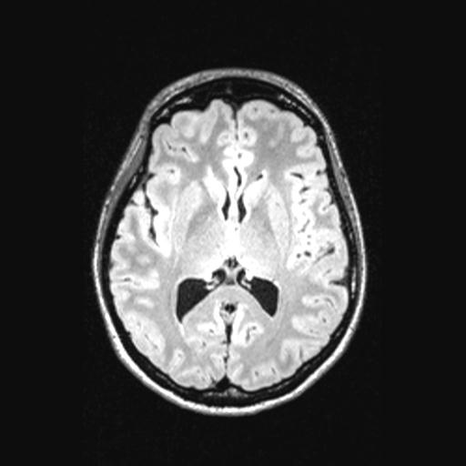 Atretic encephalocoele with inferior vermis hypoplasia (Radiopaedia 30443-31108 Axial 85).jpg