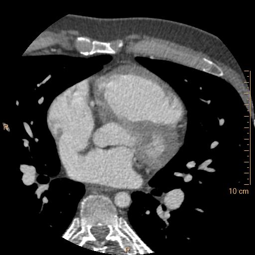 Atrial septal defect (upper sinus venosus type) with partial anomalous pulmonary venous return into superior vena cava (Radiopaedia 73228-83961 A 119).jpg