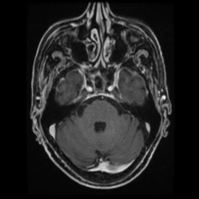 Atypical meningioma (Radiopaedia 45535-49629 Axial T1 C+ 26).jpg