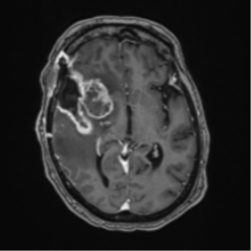 Atypical meningioma (WHO Grade II) (Radiopaedia 54742-60981 Axial T1 C+ 33).png