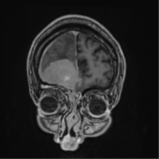 File:Atypical meningioma (WHO grade II) with brain invasion (Radiopaedia 57767-64729 Coronal T1 C+ 10).png