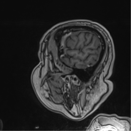 File:Atypical meningioma (WHO grade II) with brain invasion (Radiopaedia 57767-64729 Sagittal T1 C+ 57).png