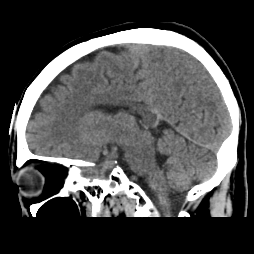 Atypical meningioma (WHO grade II) with osseous invasion (Radiopaedia 53654-59715 C 31).png