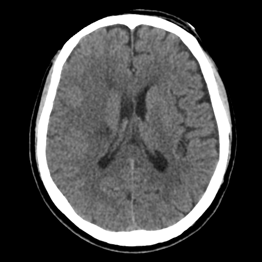 Atypical meningioma with skull invasion (Radiopaedia 34357-35649 Axial non-contrast 31).png