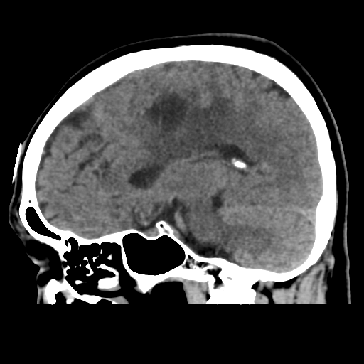 Atypical meningioma with skull invasion (Radiopaedia 34357-35649 E 24).png