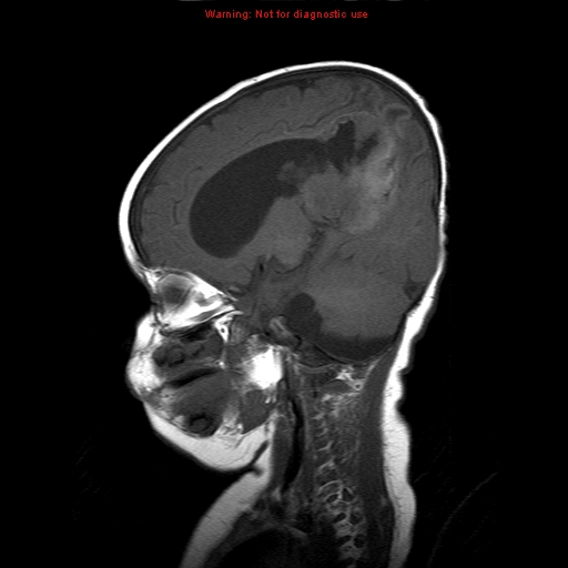 File:Atypical teratoid rhabdoid tumor (Radiopaedia 10712-11183 Sagittal T1 13).jpg