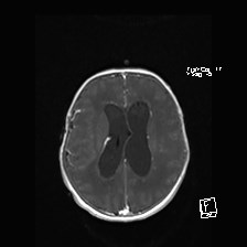 Atypical teratoid rhabdoid tumor (prenatal US and neonatal MRI) (Radiopaedia 59091-66388 Axial T1 C+ 40).jpg