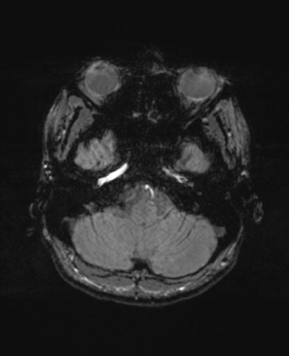 Autoimmune limbic encephalitis (Radiopaedia 30363-31005 SWI - magnitude 14).jpg