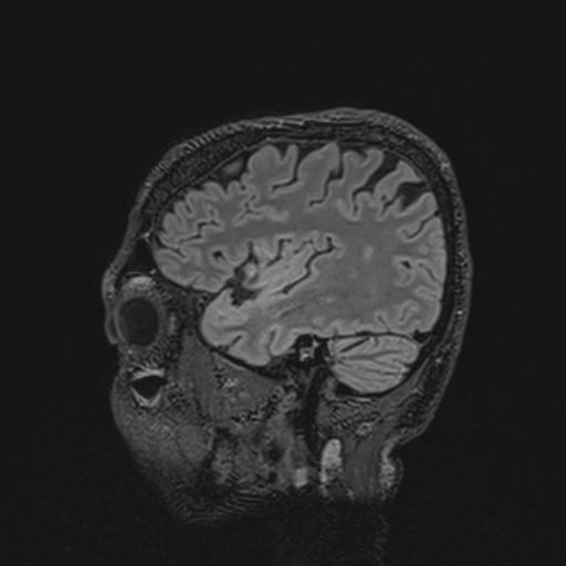 Autoimmune limbic encephalitis (Radiopaedia 30363-31005 Sagittal FLAIR 43).jpg