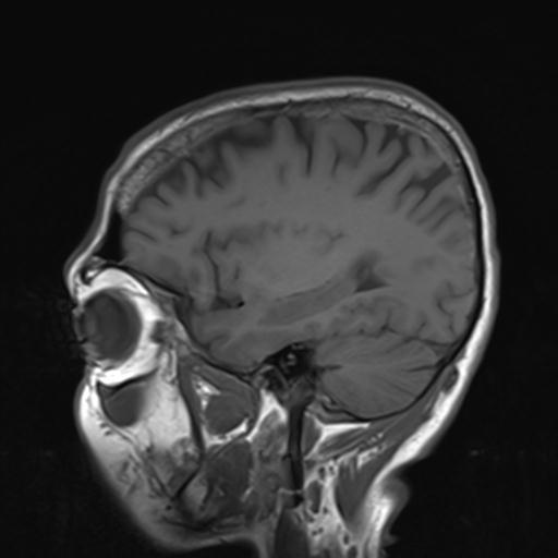 File:Autoimmune limbic encephalitis (Radiopaedia 30363-31005 Sagittal T1 19).jpg