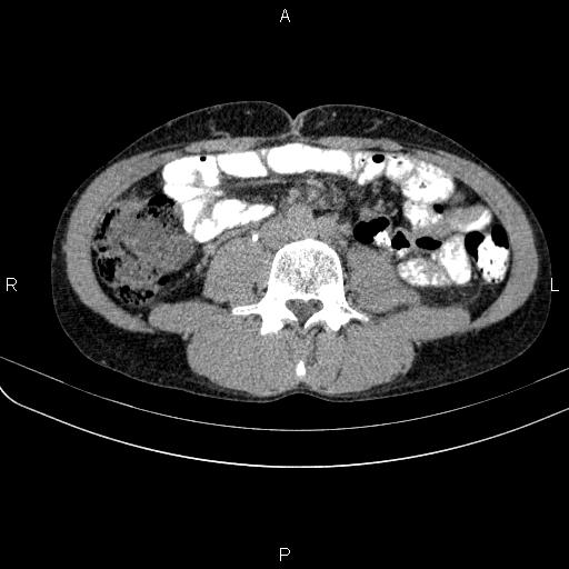 Autoimmune pancreatitis (Radiopaedia 84925-100431 Axial C+ delayed 49).jpg