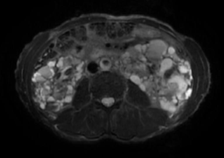 File:Autosomal dominant polycystic kidney disease (Radiopaedia 11220-11585 Axial 3).jpg