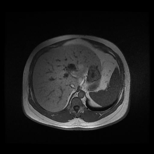 Autosomal dominant polycystic kidney disease (Radiopaedia 50259-55611 Axial 2D Dual Echo 26).jpg