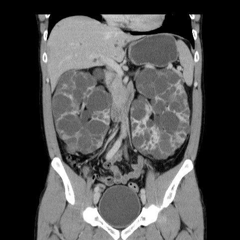 Autosomal dominant polycystic kidney disease (Radiopaedia 66349-75582 A 35).jpg