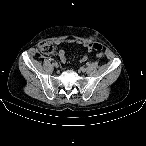 Autosomal dominant polycystic kidney disease (Radiopaedia 87830-104287 Axial non-contrast 43).jpg