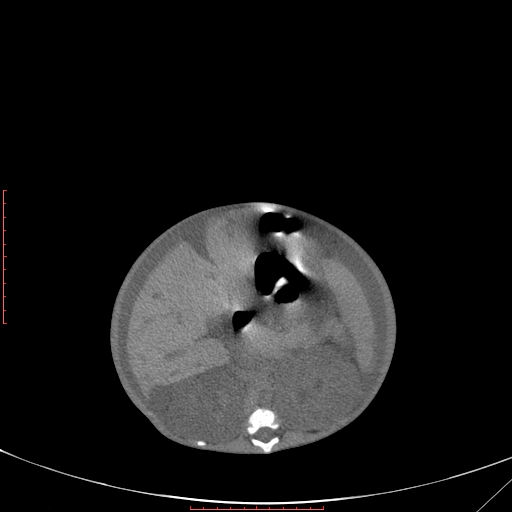 Autosomal recessive polycystic kidney disease associated with Caroli disease (Radiopaedia 61932-69984 Axial non-contrast 179).jpg