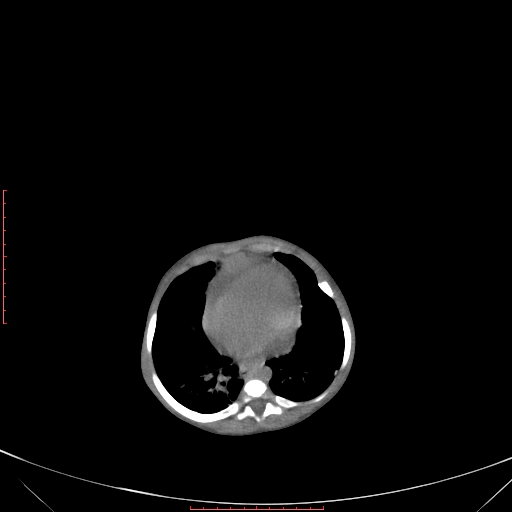 Autosomal recessive polycystic kidney disease associated with Caroli disease (Radiopaedia 61932-69984 Axial non-contrast 91).jpg