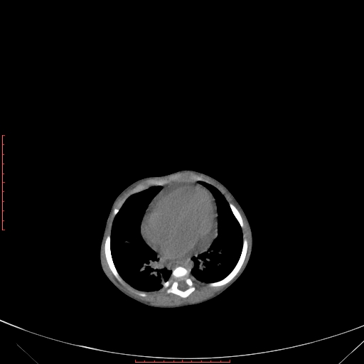 File:Autosomal recessive polycystic kidney disease associated with Caroli disease (Radiopaedia 61932-69984 B 83).jpg