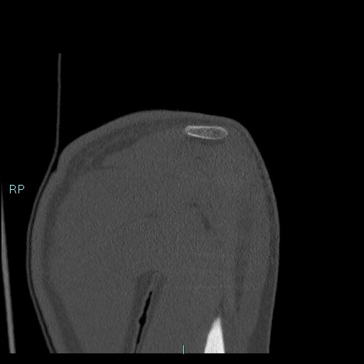Avascular necrosis after fracture dislocations of the proximal humerus (Radiopaedia 88078-104655 Coronal bone window 48).jpg