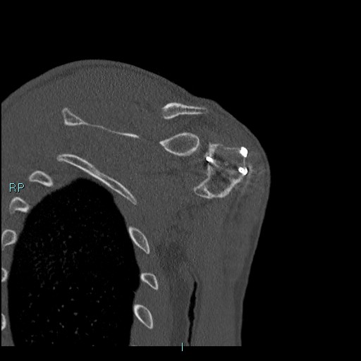 Avascular necrosis after fracture dislocations of the proximal humerus (Radiopaedia 88078-104655 Coronal bone window 95).jpg