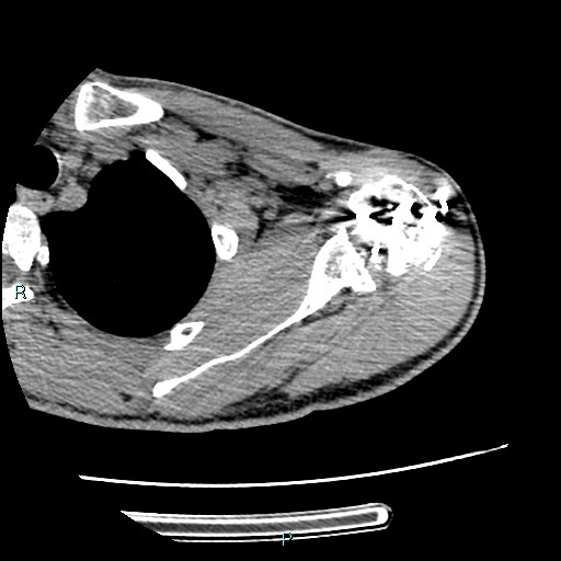 Avascular necrosis after fracture dislocations of the proximal humerus (Radiopaedia 88078-104655 D 45).jpg