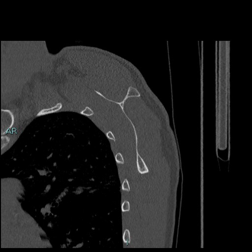 Avascular necrosis after fracture dislocations of the proximal humerus (Radiopaedia 88078-104655 Sagittal bone window 60).jpg