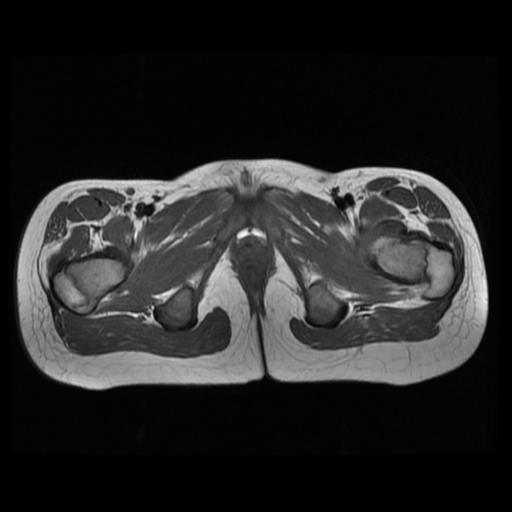 File:Avascular necrosis of the hip (Radiopaedia 29563-30067 Axial T1 14).jpg