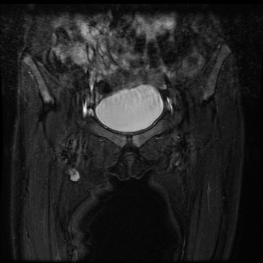 File:Avascular necrosis of the hip (Radiopaedia 29563-30067 Coronal T2 fat sat 1).jpg