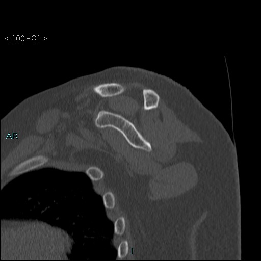 Avascular necrosis of the shoulder - Cruess stage I (Radiopaedia 77674-89887 Sagittal bone window 31).jpg