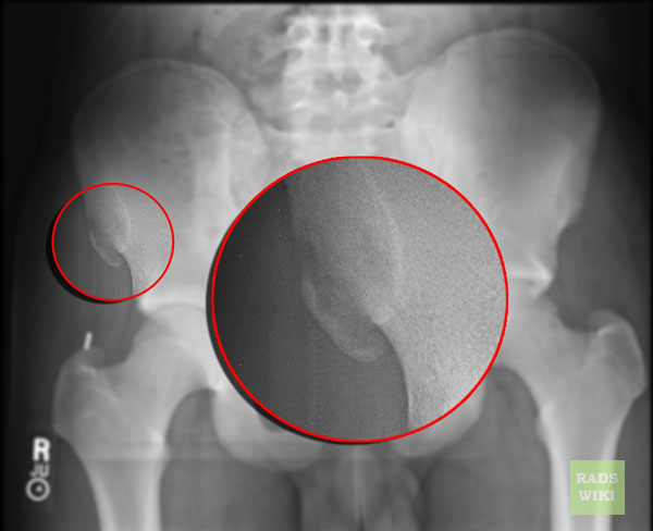 File:Avulsion fracture - anterior superior iliac spine (Radiopaedia 11227-37112 None 1).jpg