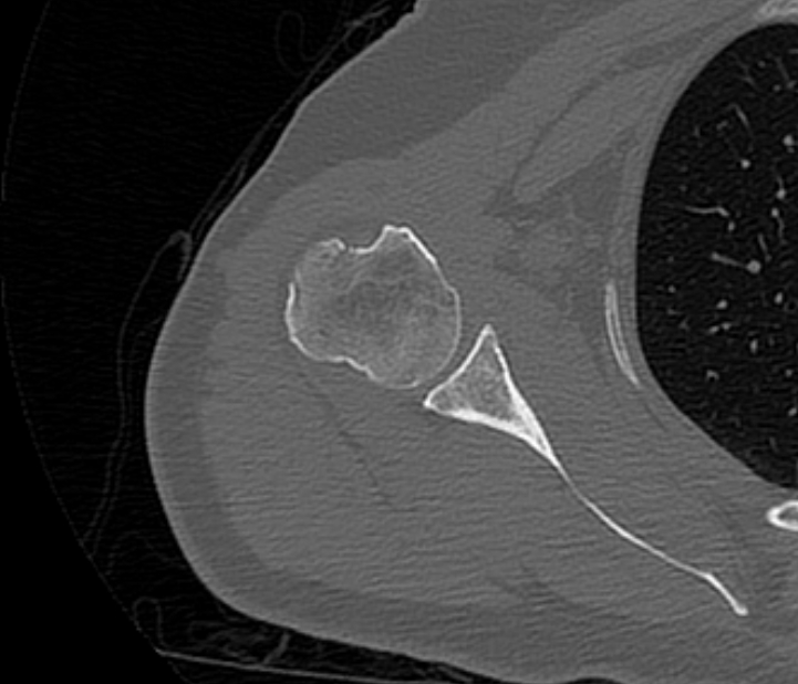 Avulsion fracture - greater tuberosity of humerus (Radiopaedia 71216-81514 Axial bone window 45).jpg