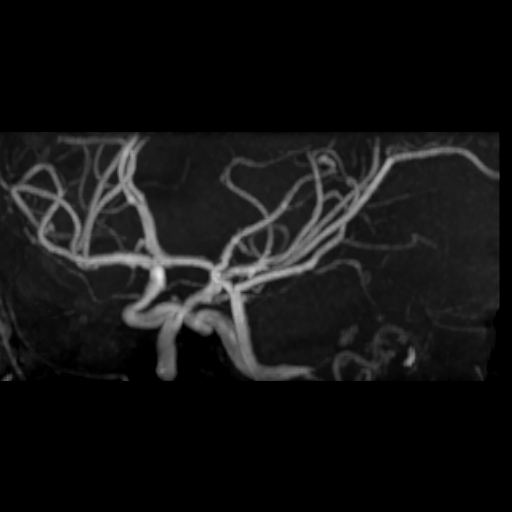 File:Azygos anterior cerebral artery (Radiopaedia 17059-16756 MRA 8).jpg