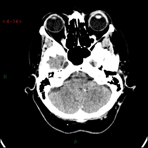 Azygos anterior cerebral artery (Radiopaedia 51987-57833 A 14).jpg