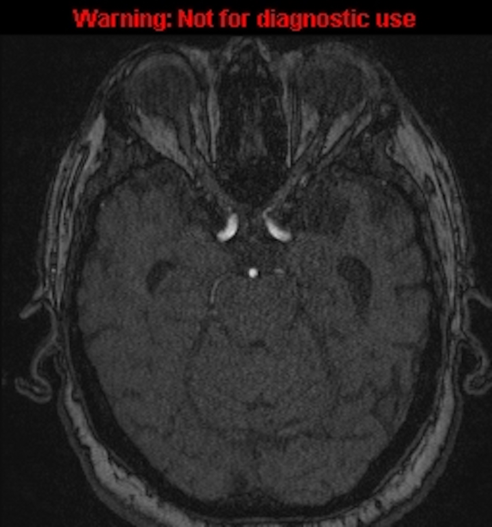 Azygos anterior cerebral artery (Radiopaedia 59325-66677 Axial MRA 57).jpg