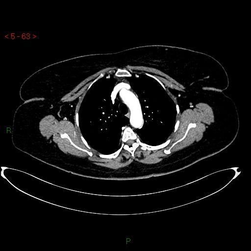 Azygos fissure and lobe (Radiopaedia 47620-52278 A 49).jpg