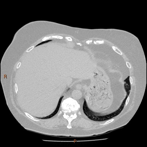 Azygos lobe (Radiopaedia 40161-42821 Axial lung window 63).jpg