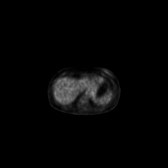 B-cell lymphoma of the mesentery (Radiopaedia 65743-74868 18F-FDG PET-CT 177).jpg