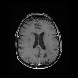 Balo concentric sclerosis (Radiopaedia 53875-59982 Axial LAVA C+ 165).jpg